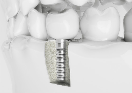 Dental Implants in Denver