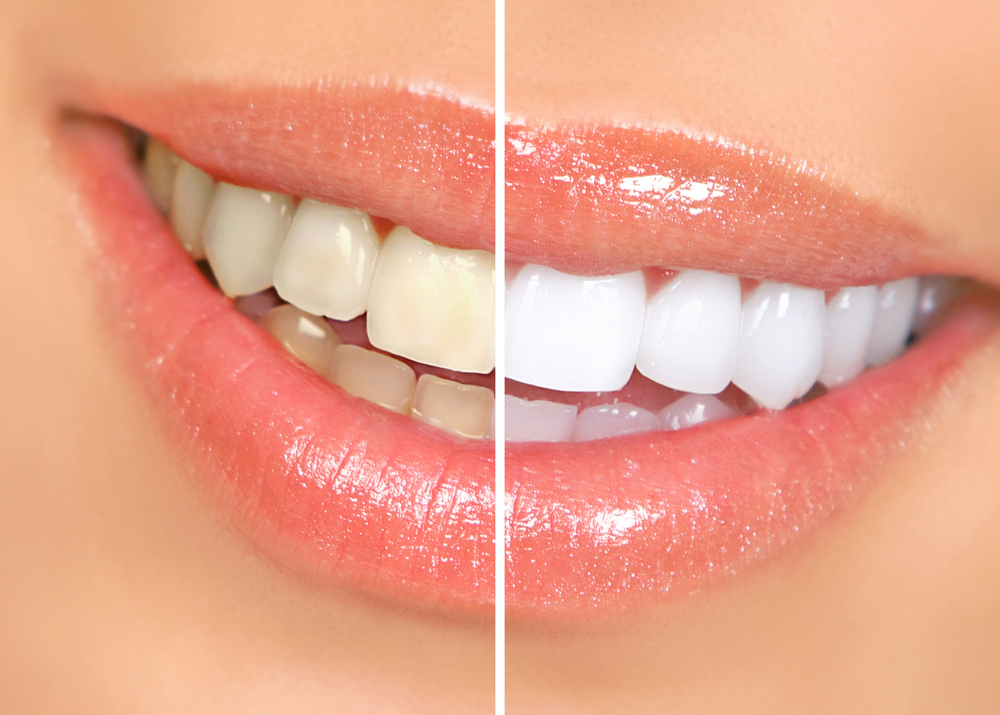 Teeth Whitening in Denver
